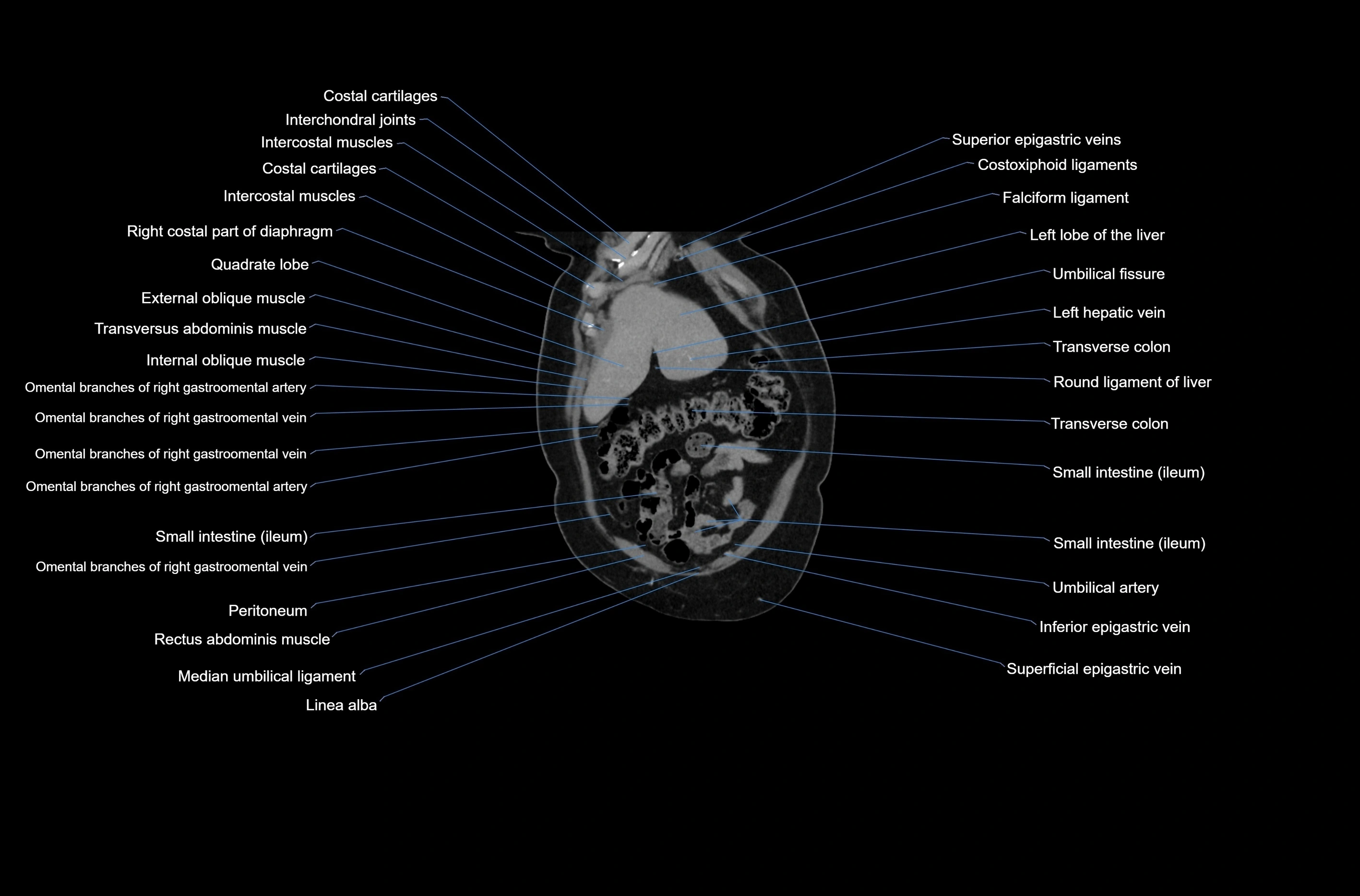 CT abdomen coronal cross sectional anatomy labelled radiology image-00014.webp